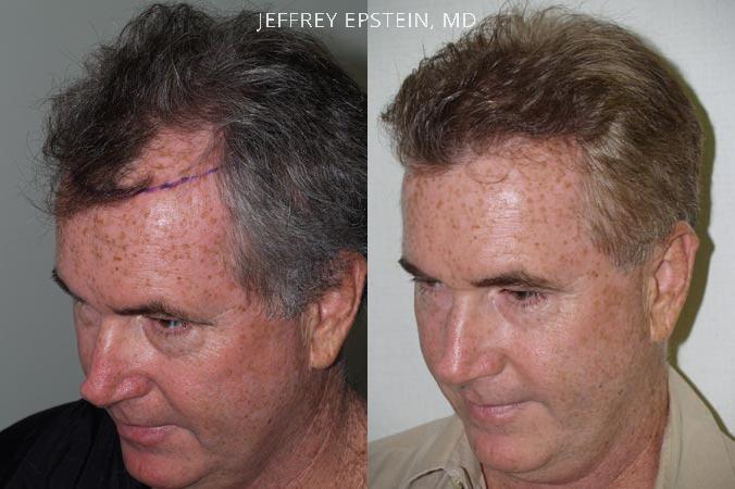 Trasplante de Pelo en Hombres Antes y después en Miami, FL, Paciente 86573