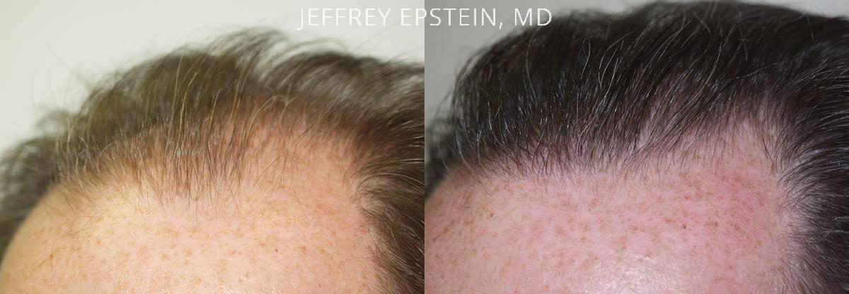 Hair Transplants for Men Before and after in Miami, FL, Paciente 38115