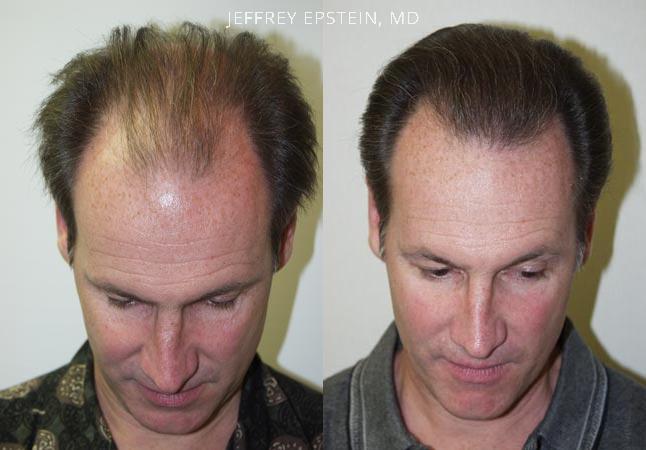 Hair Transplants for Men Before and after in Miami, FL, Paciente 38115