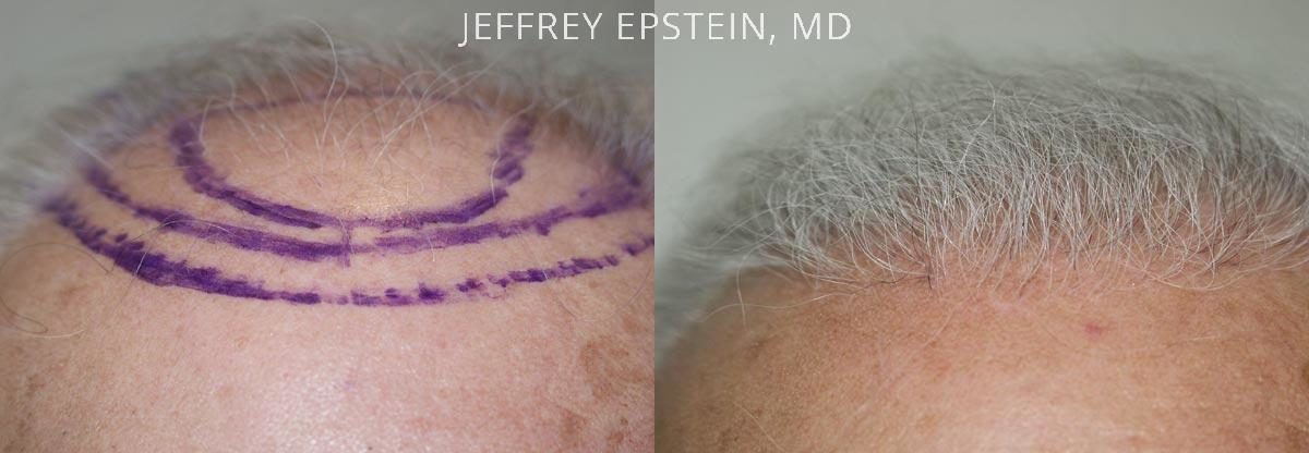 Hair Transplants for Men Before and after in Miami, FL, Paciente 38126