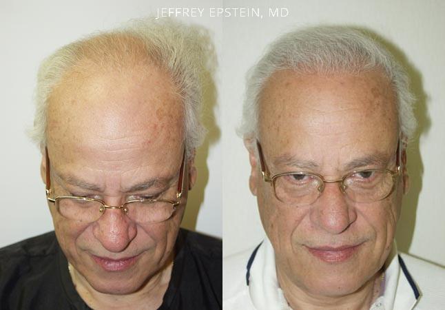 Trasplante de Pelo en Hombres Antes y después en Miami, FL, Paciente 86476