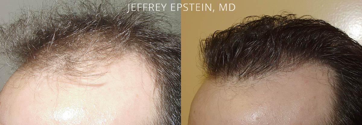 Hair Transplants for Men Before and after in Miami, FL, Paciente 38133