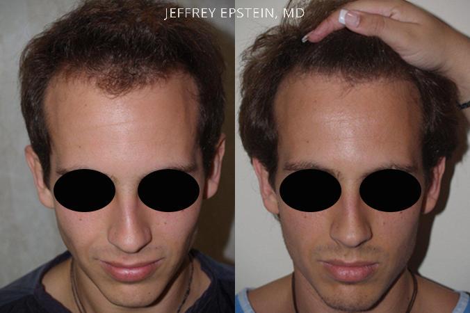 Hair Transplants for Men Before and after in Miami, FL, Paciente 38138