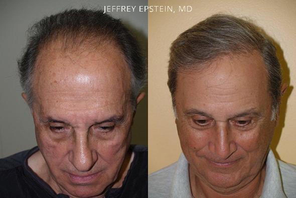Hair Transplants for Men Before and after in Miami, FL, Paciente 38150