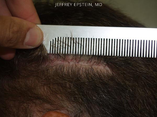 Hair Transplants for Men Before and after in Miami, FL, Paciente 38169