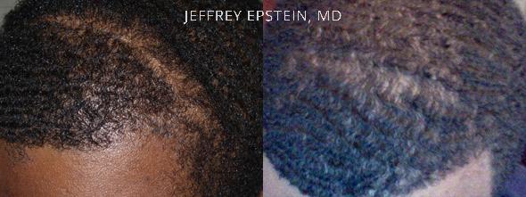 Hair Transplants for Men Before and after in Miami, FL, Paciente 38175