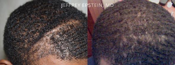 Hair Transplants for Men Before and after in Miami, FL, Paciente 38175