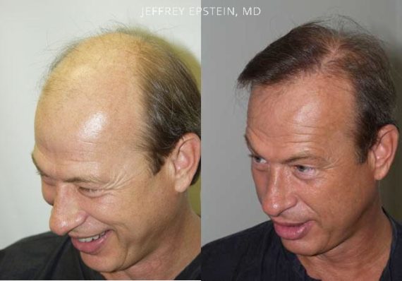 Trasplante de Pelo en Hombres Before and after in Miami, FL, Paciente 86011