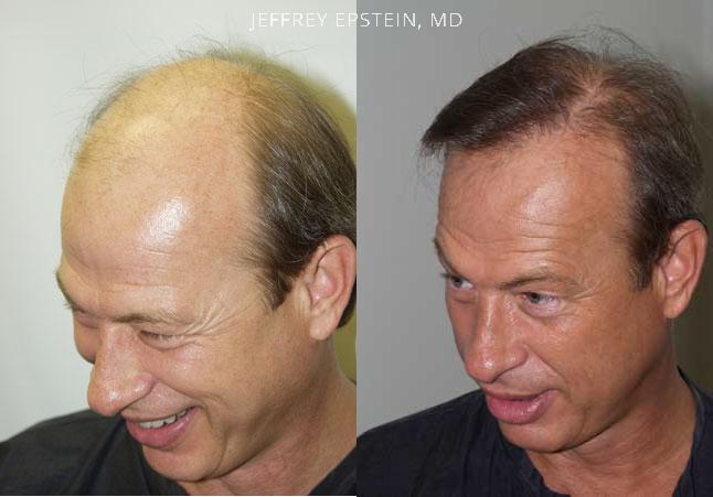 Hair Transplants for Men Before and after in Miami, FL, Paciente 38180