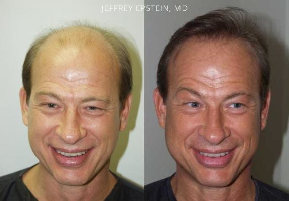 Trasplante de Pelo en Hombres Before and after in Miami, FL, Paciente 86011