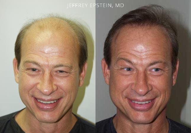Hair Transplants for Men Before and after in Miami, FL, Paciente 38180