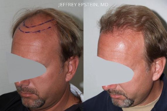 Trasplante de Pelo en Hombres Before and after in Miami, FL, Paciente 85986