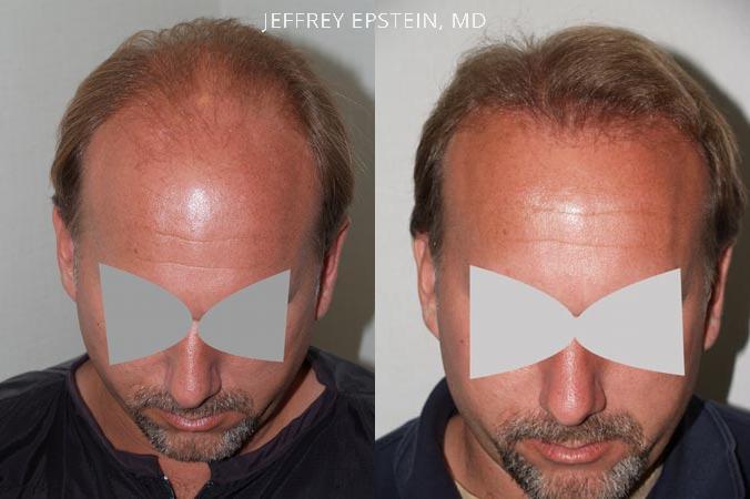 Hair Transplants for Men Before and after in Miami, FL, Paciente 38185
