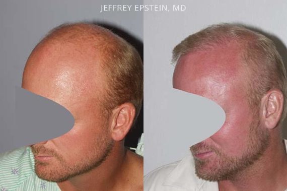 Trasplante de Pelo en Hombres Before and after in Miami, FL, Paciente 85880