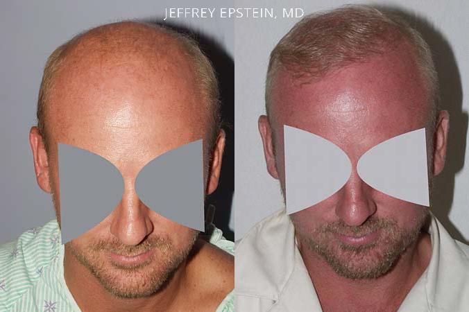 Hair Transplants for Men Before and after in Miami, FL, Paciente 38202