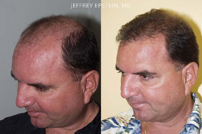 Trasplante de Pelo en Hombres Antes y después en Miami, FL, Paciente 85701