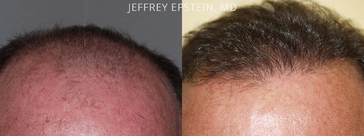 Hair Transplants for Men Before and after in Miami, FL, Paciente 38230