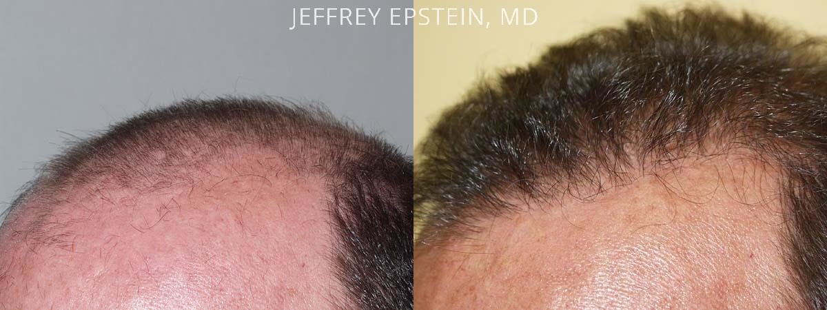 Hair Transplants for Men Before and after in Miami, FL, Paciente 38230