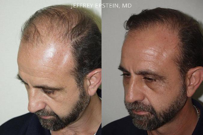 Trasplante de Pelo en Hombres Antes y después en Miami, FL, Paciente 85650