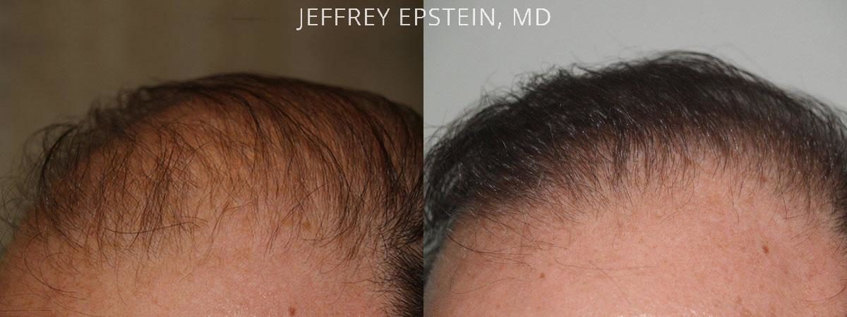 Hair Transplants for Men Before and after in Miami, FL, Paciente 38239