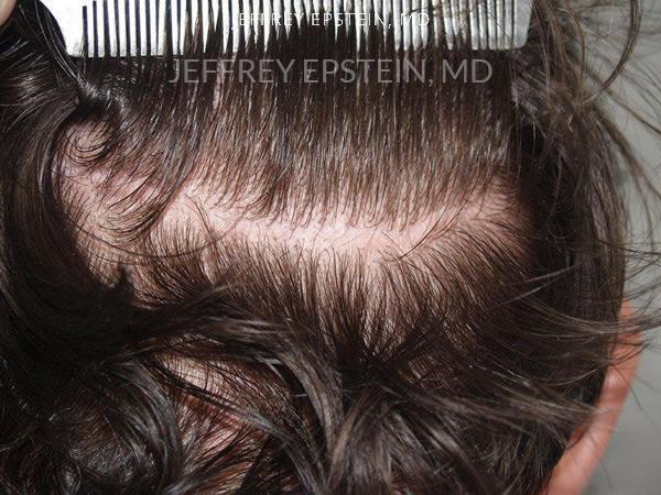Hair Transplants for Men Before and after in Miami, FL, Paciente 38239