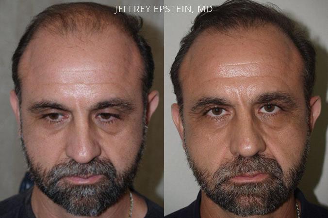 Trasplante de Pelo en Hombres Antes y después en Miami, FL, Paciente 85650