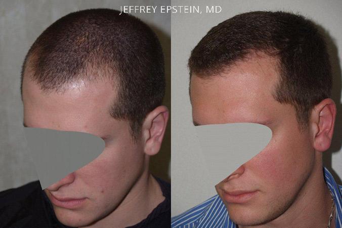 Hair Transplants for Men Before and after in Miami, FL, Paciente 38247