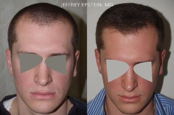Trasplante de Pelo en Hombres Before and after in Miami, FL, Paciente 85615