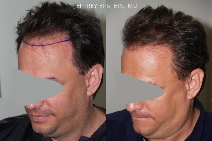 Hair Transplants for Men Before and after in Miami, FL, Paciente 38263