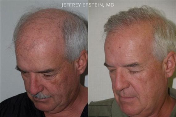 Hair Transplants for Men Before and after in Miami, FL, Paciente 38266
