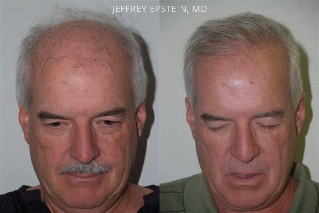 Hair Transplants for Men Before and after in Miami, FL, Paciente 38266