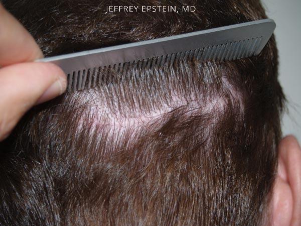 Hair Transplants for Men Before and after in Miami, FL, Paciente 38278