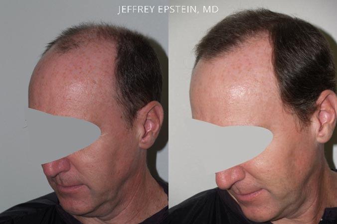 Hair Transplants for Men Before and after in Miami, FL, Paciente 38278