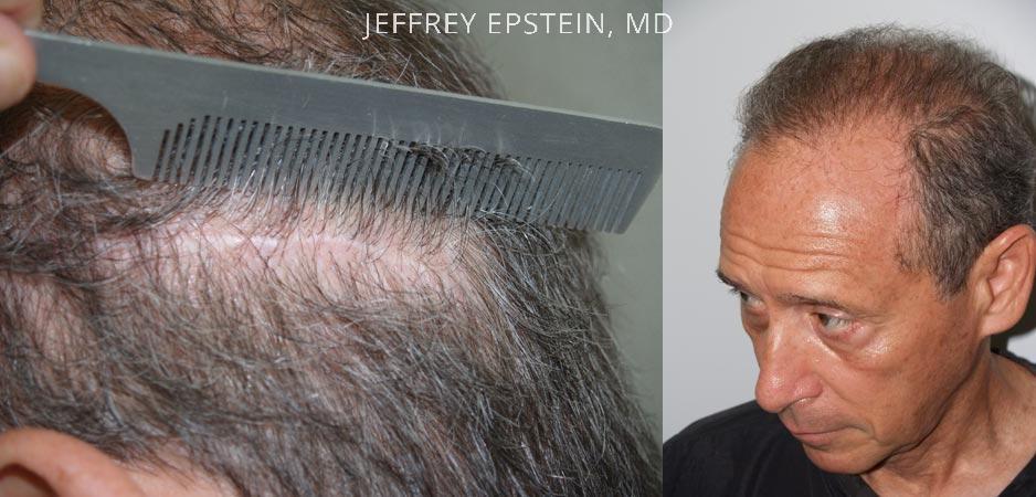 Hair Transplants for Men Before and after in Miami, FL, Paciente 38287