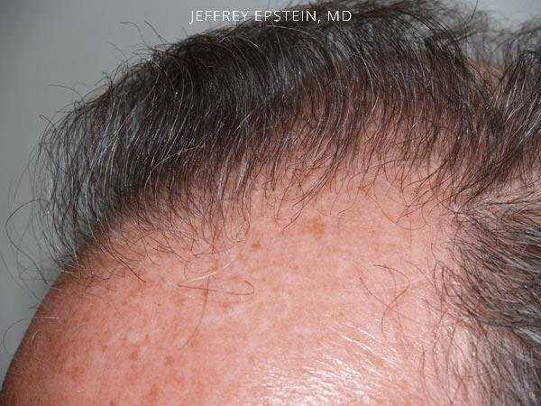 Hair Transplants for Men Before and after in Miami, FL, Paciente 38287