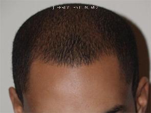 Hair Transplants for Men Before and after in Miami, FL, Paciente 38297