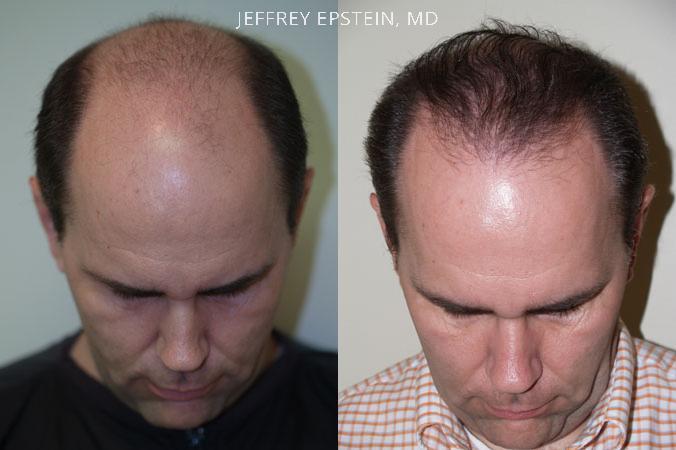 Hair Transplants for Men Before and after in Miami, FL, Paciente 38305