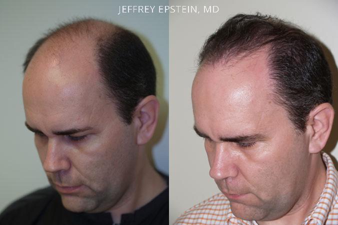Hair Transplants for Men Before and after in Miami, FL, Paciente 38305