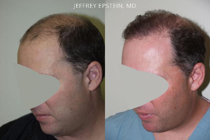 Hair Transplants for Men Before and after in Miami, FL, Paciente 38313