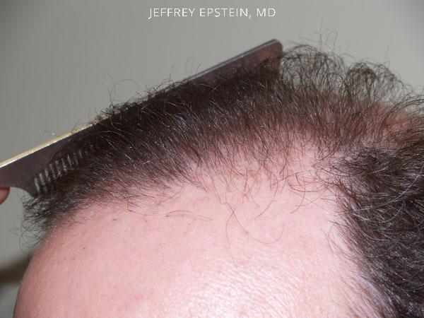 Hair Transplants for Men Before and after in Miami, FL, Paciente 38313