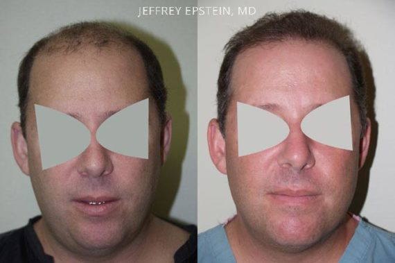 Trasplante de Pelo en Hombres Before and after in Miami, FL, Paciente 85150