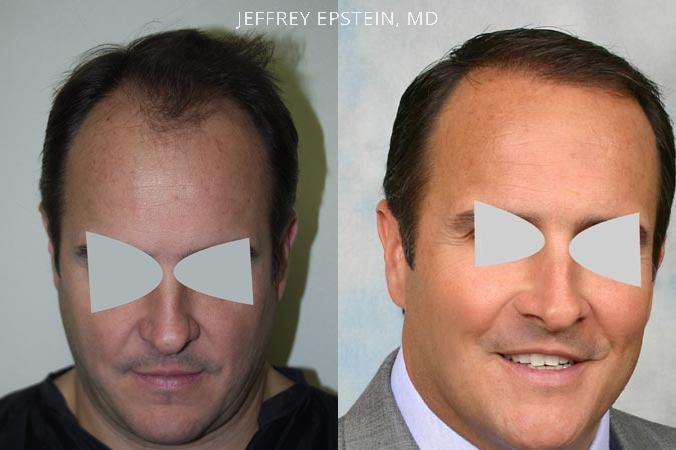 Hair Transplants for Men Before and after in Miami, FL, Paciente 38319
