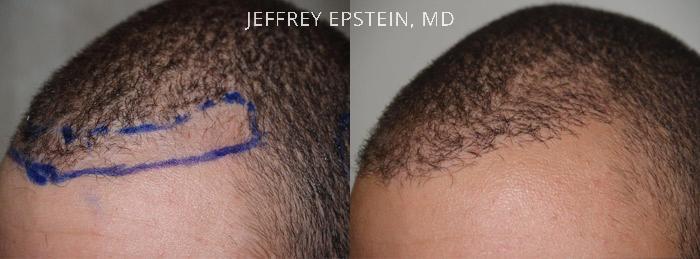 Hair Transplants for Men Before and after in Miami, FL, Paciente 38322