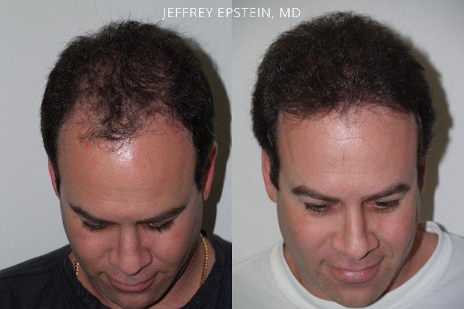 Hair Transplants for Men Before and after in Miami, FL, Paciente 38326