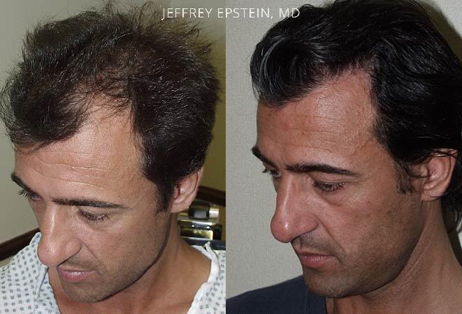 Hair Transplants for Men Before and after in Miami, FL, Paciente 38341