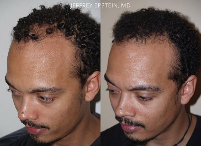 Hair Transplants for Men Before and after in Miami, FL, Paciente 38349