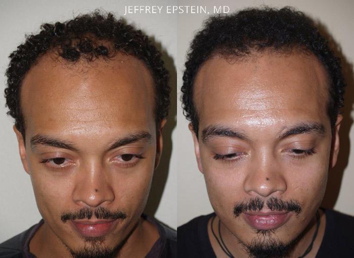 Hair Transplants for Men Before and after in Miami, FL, Paciente 38349
