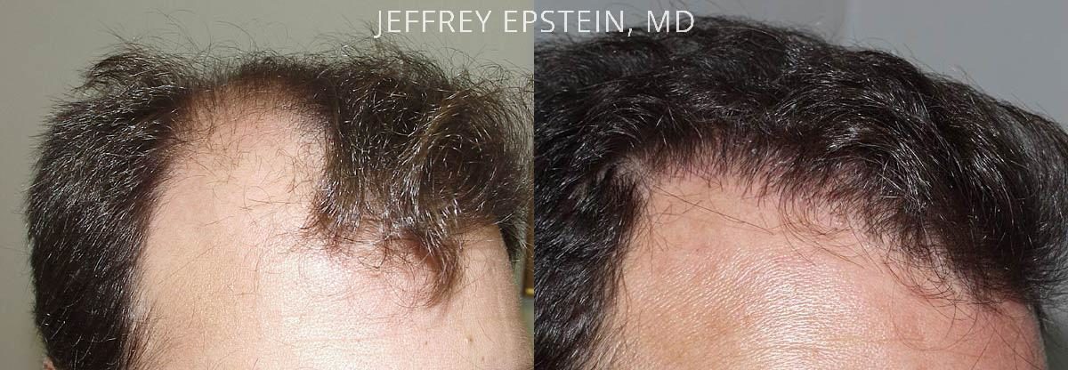 Hair Transplants for Men Before and after in Miami, FL, Paciente 38354