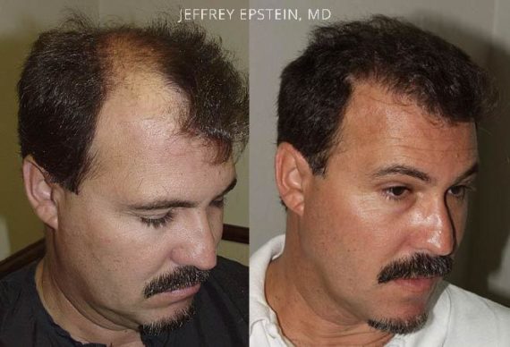 Trasplante de Pelo en Hombres Before and after in Miami, FL, Paciente 84919