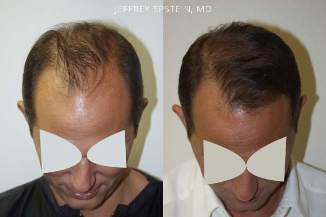 Hair Transplants for Men Before and after in Miami, FL, Paciente 38359